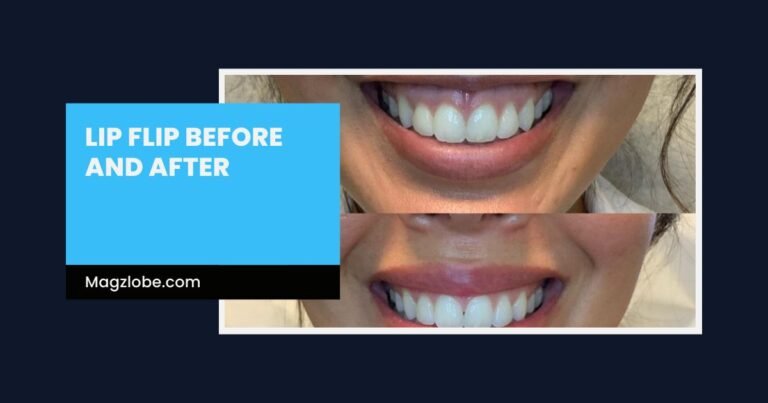 lip flip before and after